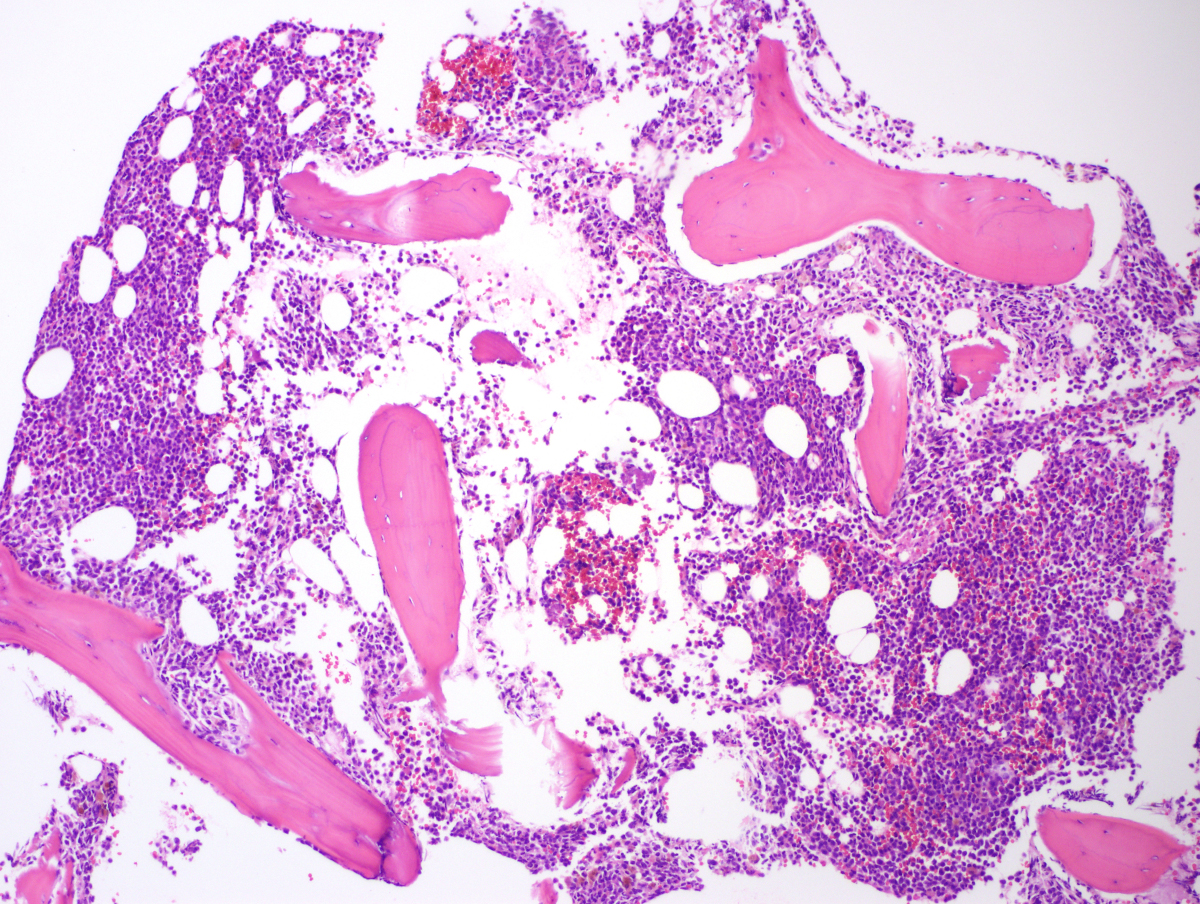 AML core biopsy